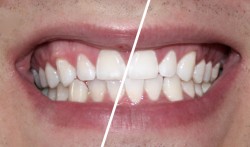 Whitestrips Ergebnis